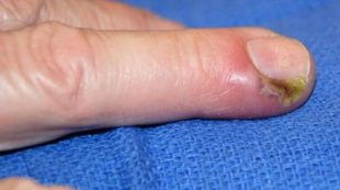 Воспаление на коже возле ногтей